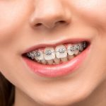 What To Eat with Braces the First Week